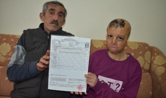 Suriye'de bomba düşen evlerinde yüzü yanan Evin, 109 ameliyat oldu