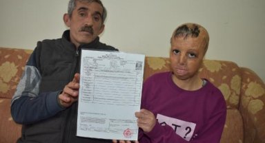 Suriye'de bomba düşen evlerinde yüzü yanan Evin, 109 ameliyat oldu
