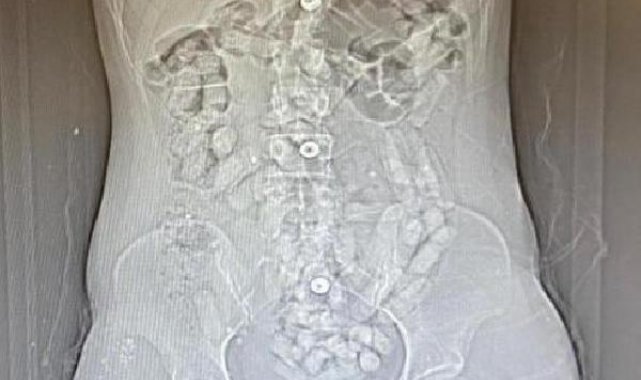 İranlı 2 kadının midelerinden 693,3 gram Afyon sakızı çıktı