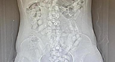 İranlı 2 kadının midelerinden 693,3 gram Afyon sakızı çıktı