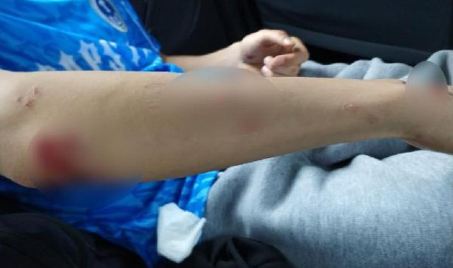 Köpeklerin saldırdığı lise öğrencisi yaralandı