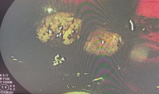 Midesine sakladığı uyuşturucu dolu kapsüller patlayan İsveçli öldü
