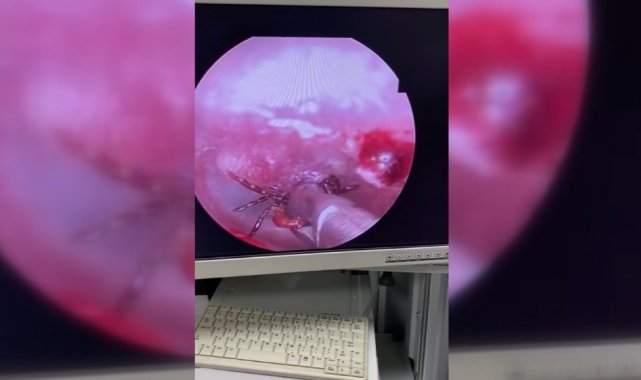 Kulak ağrısıyla hastaneye gitti, kulağından kene çıktı