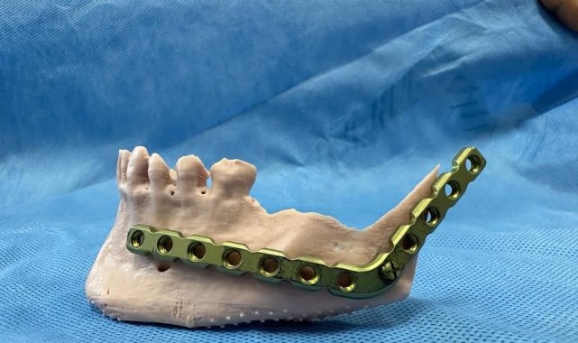 3D modelleme üzerinde test yapıldı, ardından hastaya uygulandı