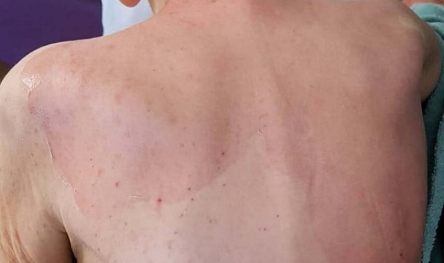 Huzurevindeki ölümde beklenen rapor geldi: Dermatolojik hastalık tespit edilmedi