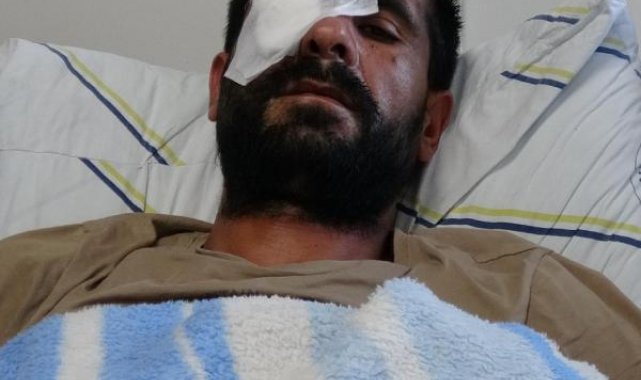 Pusu kuran hasımları av tüfeğiyle vurdu, bir gözünü kaybetti