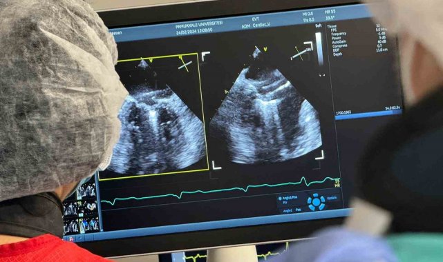 Denizli'de ilk defa ameliyatsız mitral kapak yetmezliği tamiri yapıldı