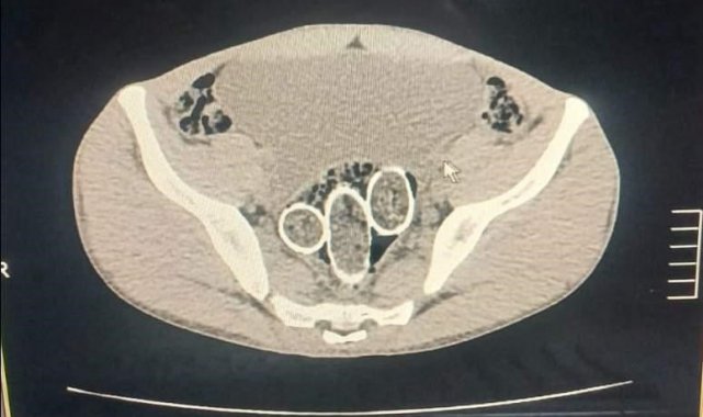 320 gram uyuşturucuyu mide ve rahme sakladılar