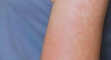 ABD'nin Kansas eyaletinde 23 kızamık vakası bildirildi