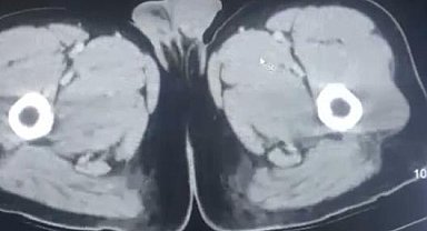 Midelerinden uyuşturucu çıkan İranlı 3 şüpheli, tutuklandı