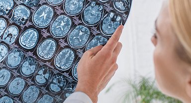 İngiltere'de beyin kanaması geçiren bir kişi, kafatası parçasını midesinde taşıdı