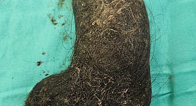 9 yaşındaki çocuğun midesinden saç yumağı çıktı