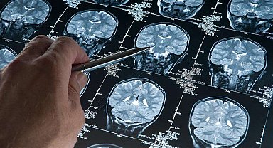 Alzheimer araştırmalarında riski artıran genetik varyant bulundu