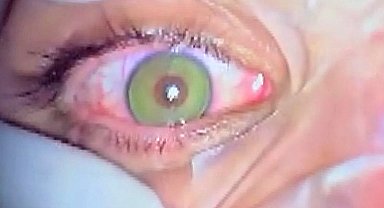 Göz rengini kalıcı olarak değiştirmek mümkün; en çok mavi ve yeşil uygulanıyor