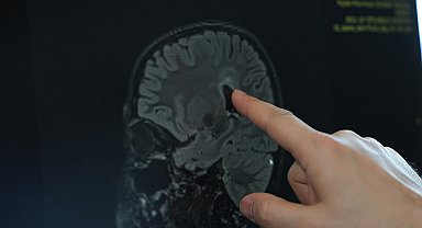 'Vücuttaki aşırı kasılmaların nedeni serebral palsi olabilir'