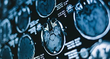 Araştırma: Covid-19 beyni yaşlandırdı