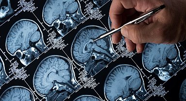 Alzheimer tedavisinde 'lityum' umudu