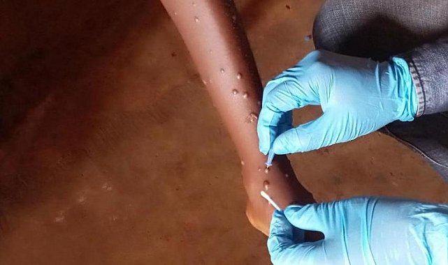 Gana'da M-çiçeği vaka sayısı 302'ye yükseldi