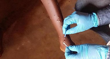 Gana'da M-çiçeği vaka sayısı 302'ye yükseldi