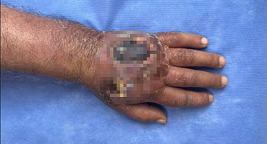 İstanbul - Hırsızın ısırığı kolundan ediyordu; vaka literatüre girmeye aday