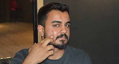 Lazer epilasyonda yüzü yandı, işletme hakkında şikayetçi oldu