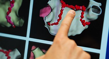 'Ablasyon tedavisinde çoğu hasta aynı gün taburcu ediliyor'