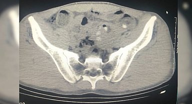 Midelerinde uyuşturucu ile yakalanan yabancı uyruklu 3 şüpheli tutuklandı