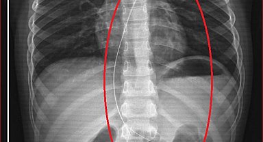 Salatalık yutunca rahatsızlandı; 3 yıl önce vücudunda 18 santimlik kateter unutulduğu ortaya çıktı