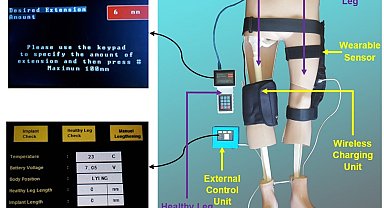 Türk akademisyenler, kemik kanseri tedavisi için tümör protezi geliştirdi