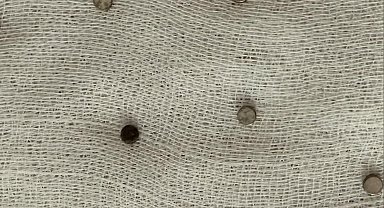 3 yaşındaki çocuğun yuttuğu 19 mıknatıs endoskopiyle çıkarıldı