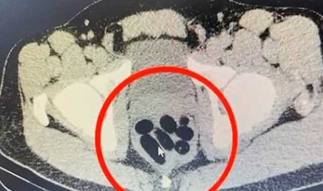 Midesinden yarım kilo metamfetamin çıktı