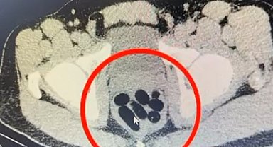 Midesinden yarım kilo metamfetamin çıktı