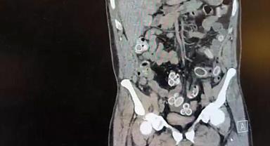 Mide değil esrar deposu! Tutuklandı…