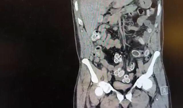 Mide değil esrar deposu! Tutuklandı…