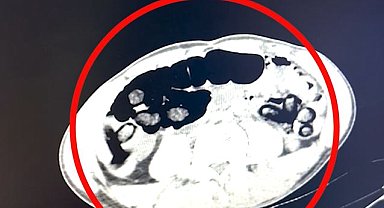 Batman'da 4 şüphelinin midesinden 2 kilo 700 gram uyuşturucu çıktı