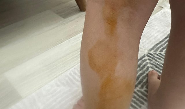 Sokak köpeğinin saldırısına uğrayan Erva yaralandı