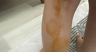 Sokak köpeğinin saldırısına uğrayan Erva yaralandı