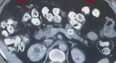 2 kilo 675 gram Afyon sakızı yuttuğu tespit edilen 3 şüpheli tutuklandı