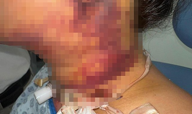 Estetik ameliyatı sonrası yoğun bakımda 2 gün tedavi gördü, doktor hakkında şikayetçi oldu