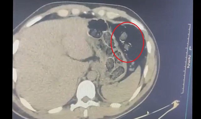 Midelerinden uyuşturucu taşıyan 2 şüpheli tutuklandı