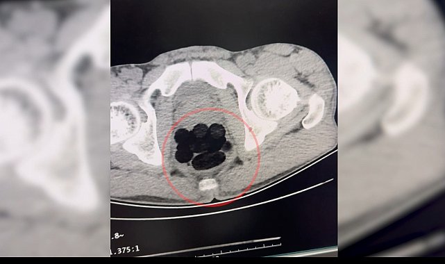 Midesinden uyuşturucu çıkan şüpheli, tutuklandı